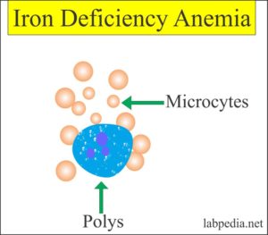 Iron deficiency anemia picture