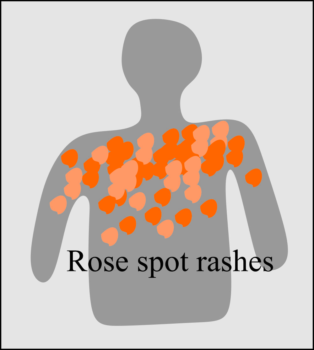 pic Rose Spot Salmonella Rash labpedia net