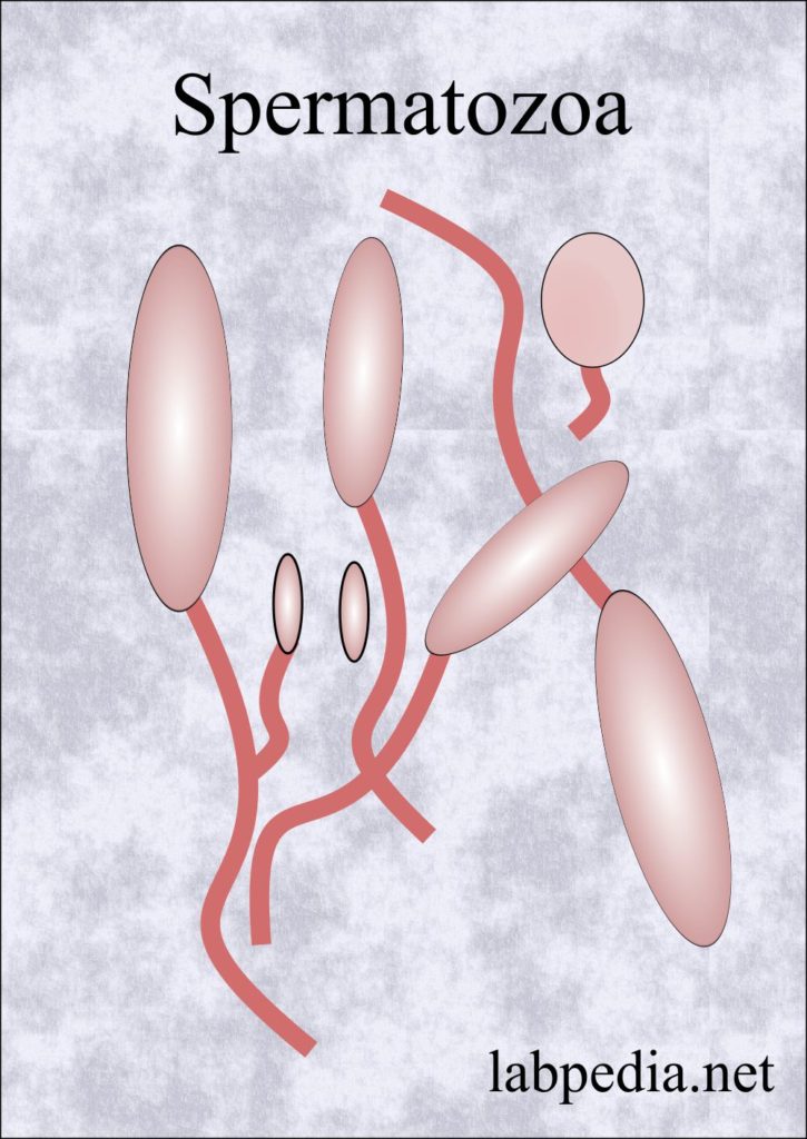 Intrauterine insemination, IUI (Semen Preparation)