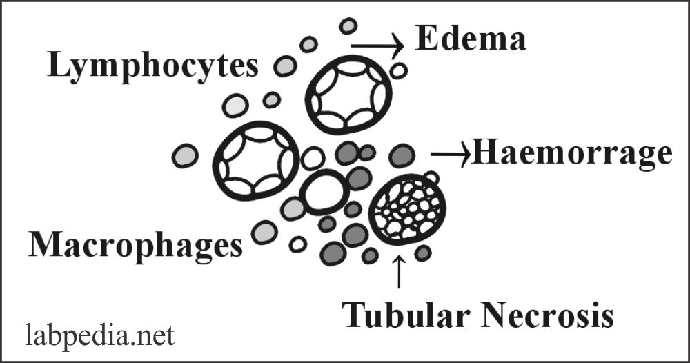 Fig 118: Acute Cellular Rejection