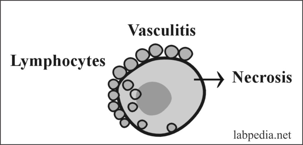 Fig 132: Vasculitis in SLE