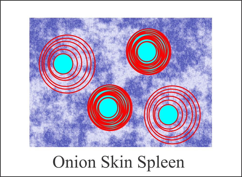 Fig 137: Onion Skin Spleen in SLE