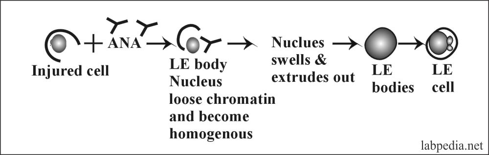 Fig 139: L E cell Phenomenon in Systemic Lupus erythematosus (SLE)