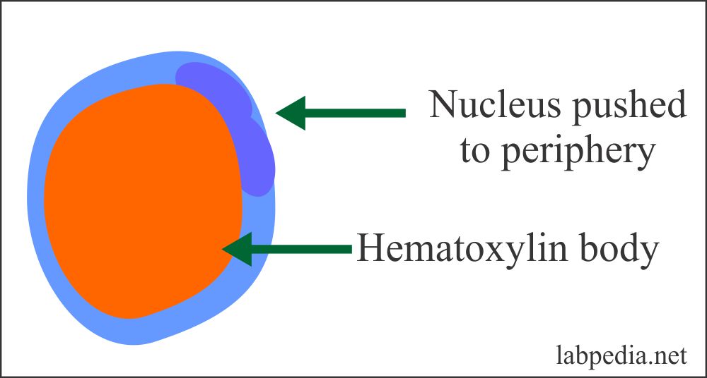 Fig 14: L E Cell Phenomenon in Systemic Lupus erythematosus