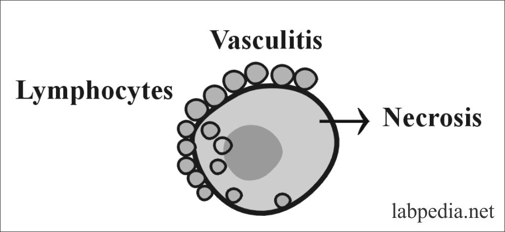 Fig 144: Vasculitis in Polyarteritis Nodosa