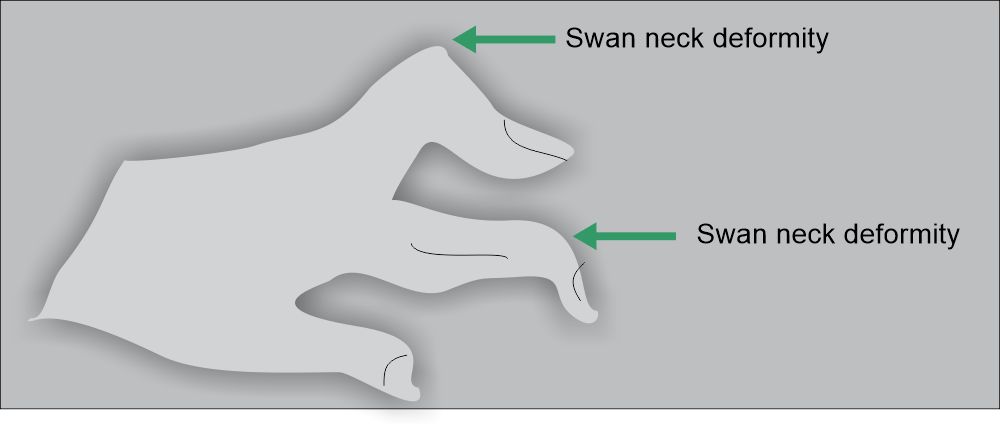 Rheumatoid Arthritis swan neck deformity