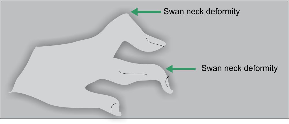 Swan neck deformity in Rheumatoid Arthritis