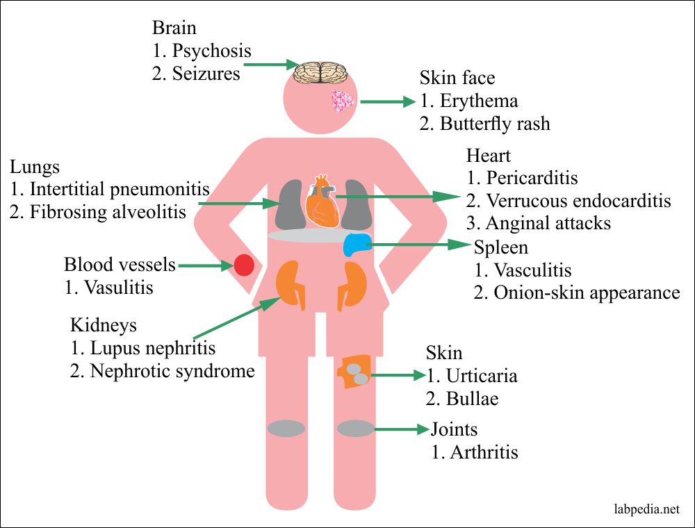 SLE signs and symptoms