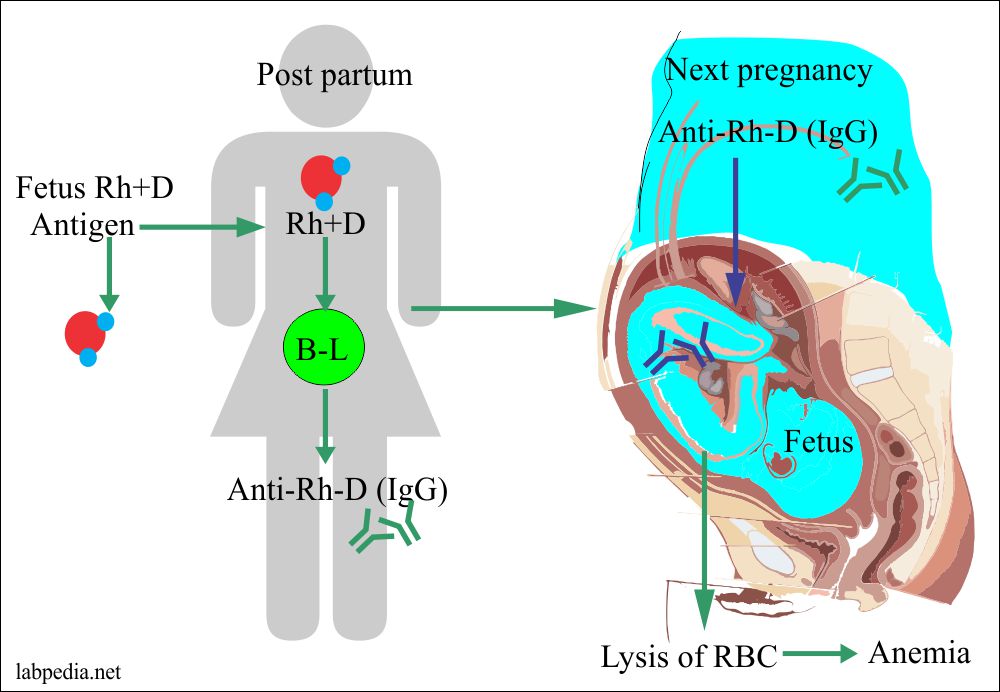 Hemolytic disease of the newborn