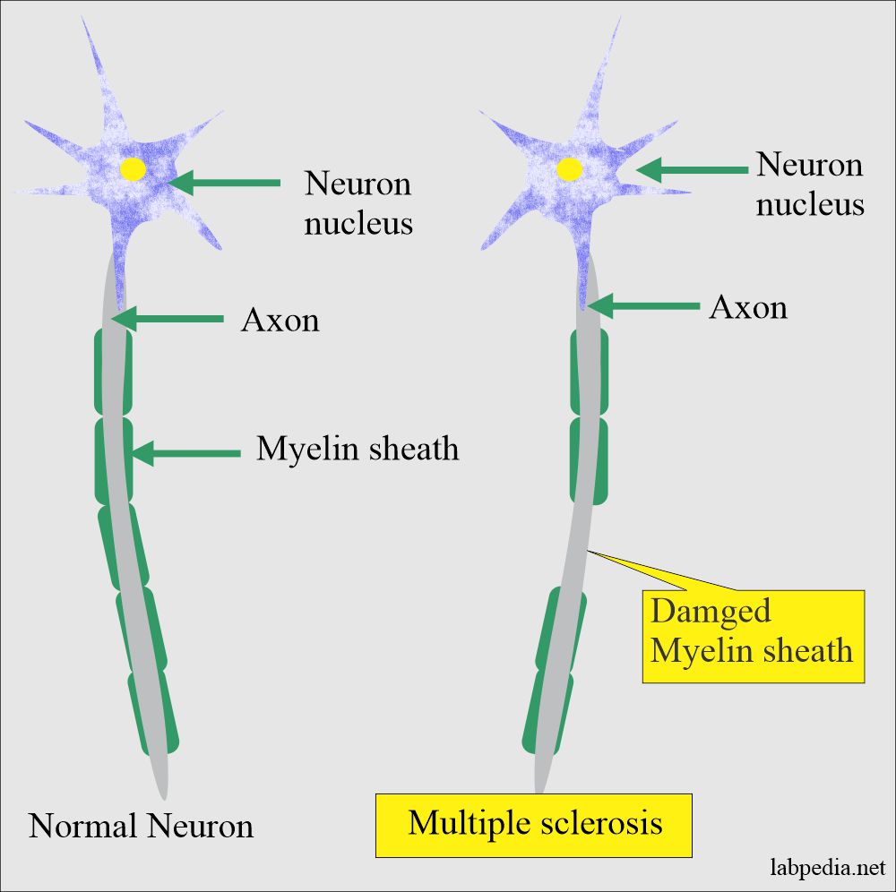 Multiple sclerosis changes in neuron