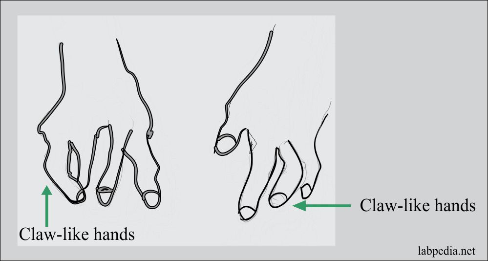 Claw-like hands in Progressive Systemic Sclerosis
