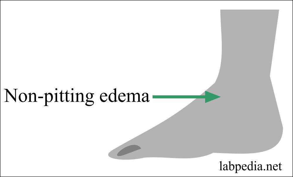 Non-pitting edema in Progressive Systemic Sclerosis