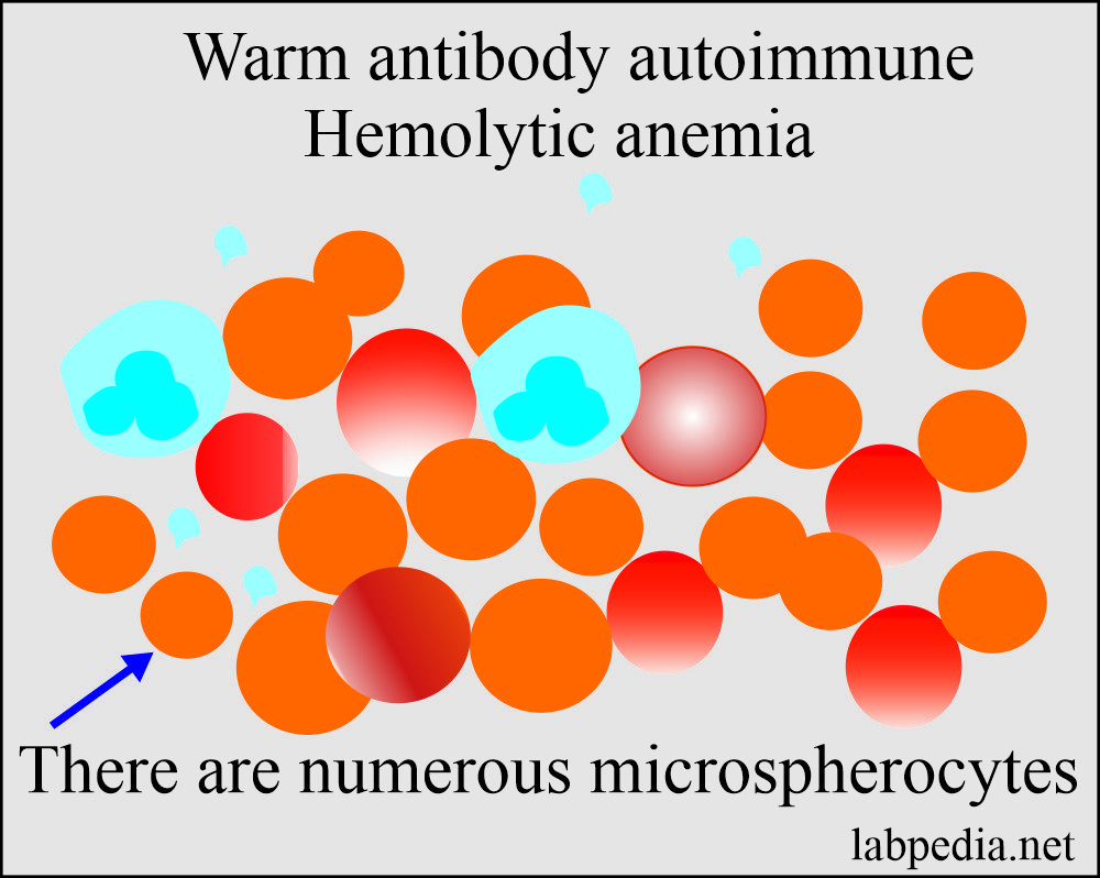 Warm antibody autoimmune hemolytic anemia peripheral blood picture