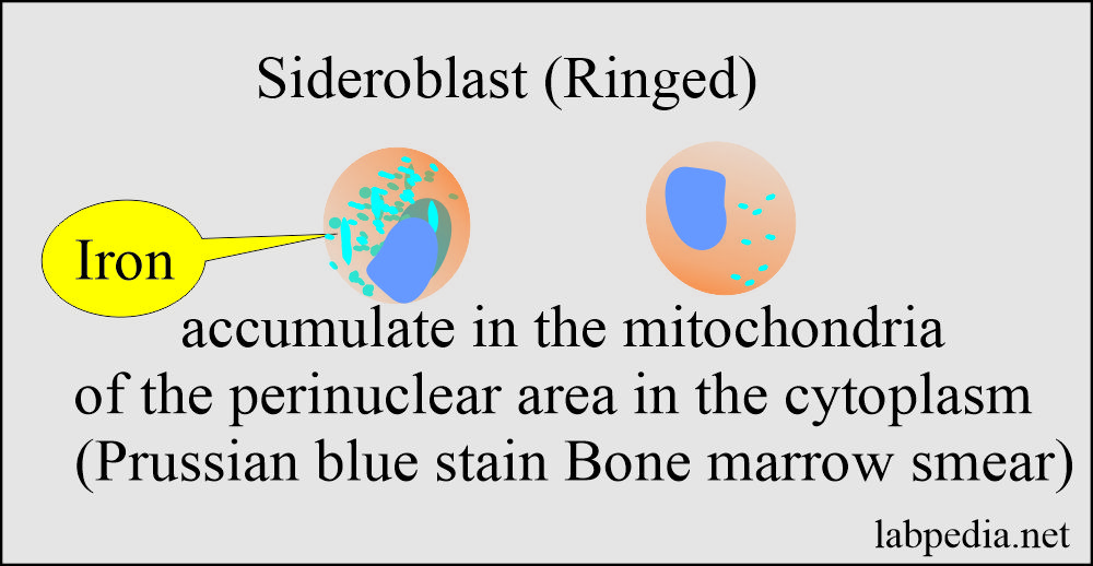 Sideroblast in bone marrow smear