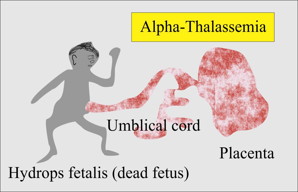 Alpha-Thalassemia leading to hydrops fetalis