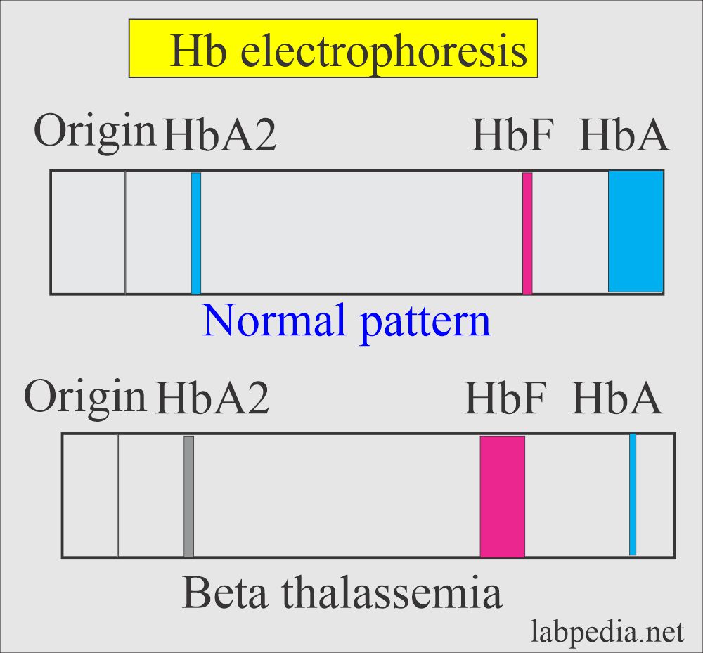 Hemoglobin electrophoresis of thalassemia