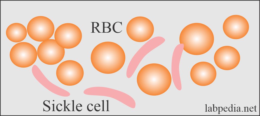 sickle cell phenomenon
