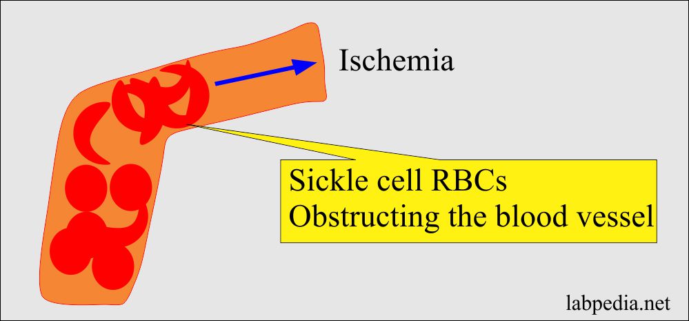 Sickle cells leading to ischemia
