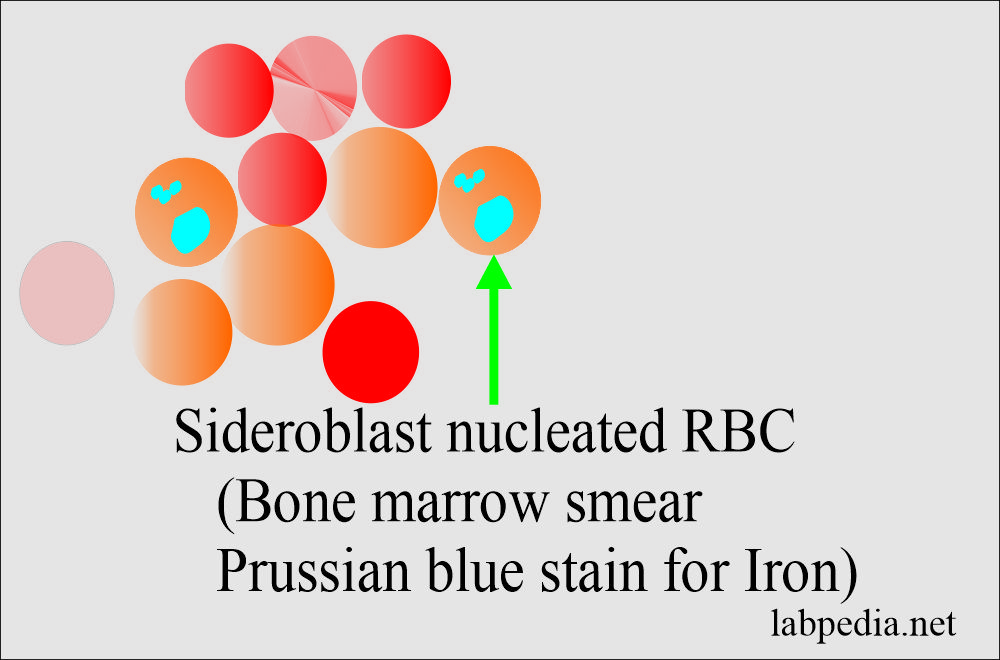 Sideroblastic anemia showing sideroblast in bone marrow smear