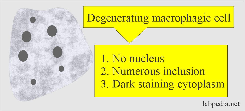 Stool smear showing degenerated macrophagic cell